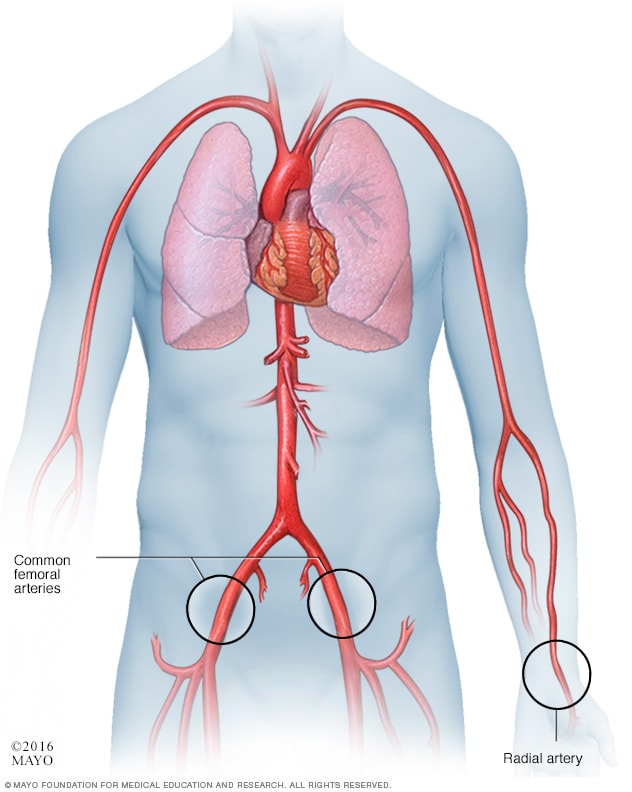 طرق استخدام أنبوب القسطرة خلال إجراء القسطرة القلبية.