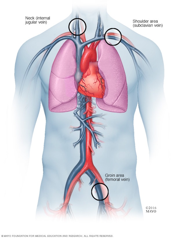心脏消融术中导管的插入位置。