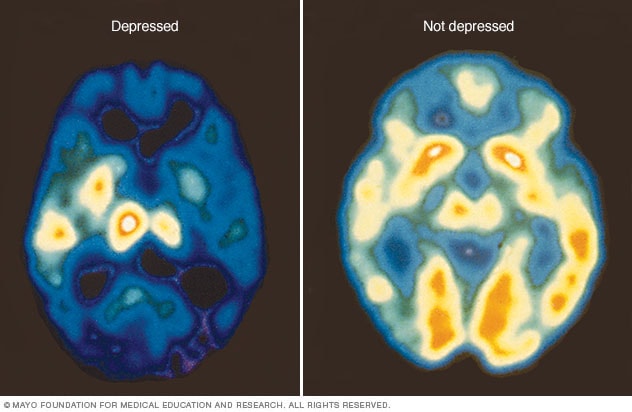 正电子发射断层成像（PET）扫描图像显示正常的脑活动（右侧）和由抑郁症导致的脑活动减少（左侧） 