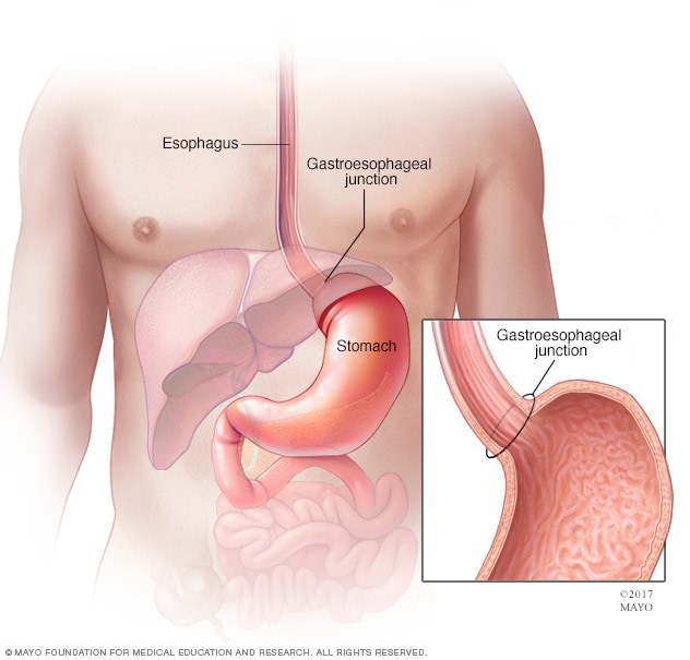 El esófago, la unión gastroesofágica y el estómago