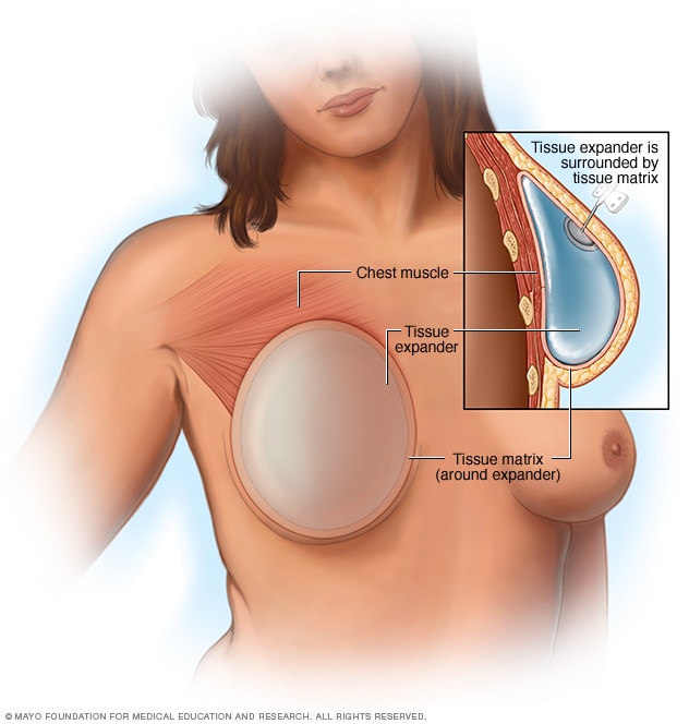 在胸肌上方置入乳房植入物的乳房再造术