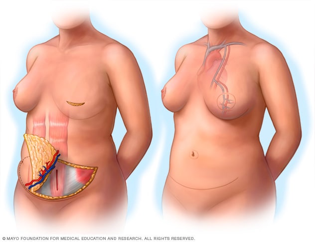 Imágenes durante la reconstrucción mamaria y después de esta a través del procedimiento con colgajo perforador epigástrico inferior profundo