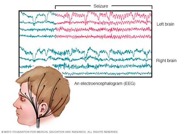 Actividad cerebral registrada por electroencefalograma