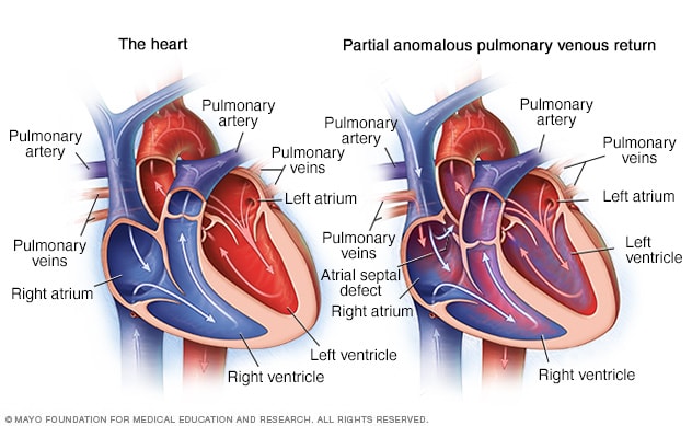 Partial anomalous pulmonary venous return