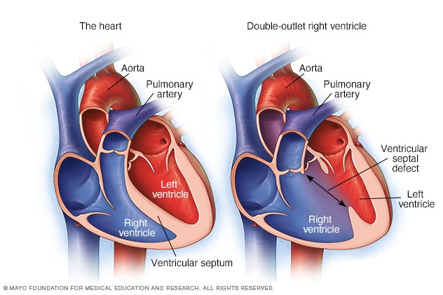 Typical heart and heart with double-outlet right ventricle