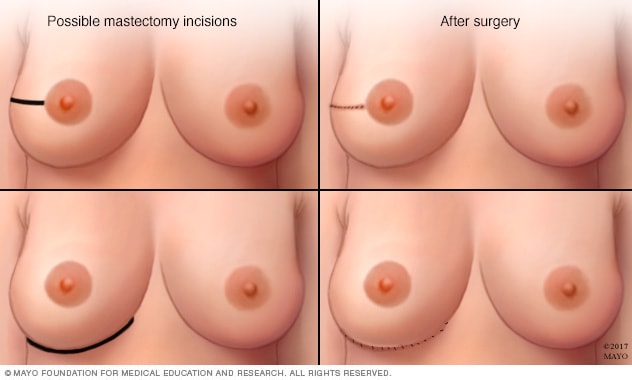 保留乳头乳房切除术常用的切口