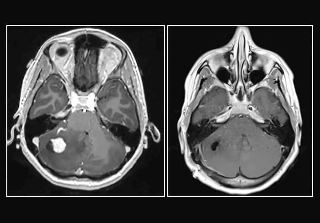 Resonancia magnética prequirúrgica y posquirúrgica de hemangioblastoma