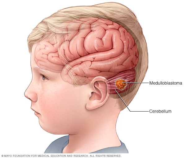 Niño con un tumor cerebral meduloblastoma