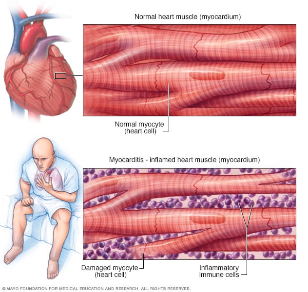 Inflammation of the heart muscle (myocarditis).