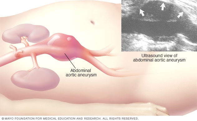腹主动脉瘤的腹部超声波图像