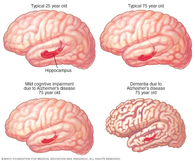 التغيرات في بنية الدماغ في حالات الإصابة بالاختلال المعرفي المعتدل وداء الزهايمر