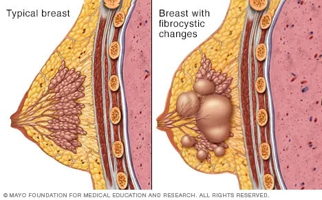 Tejido mamario normal y un seno con cambios fibroquísticos
