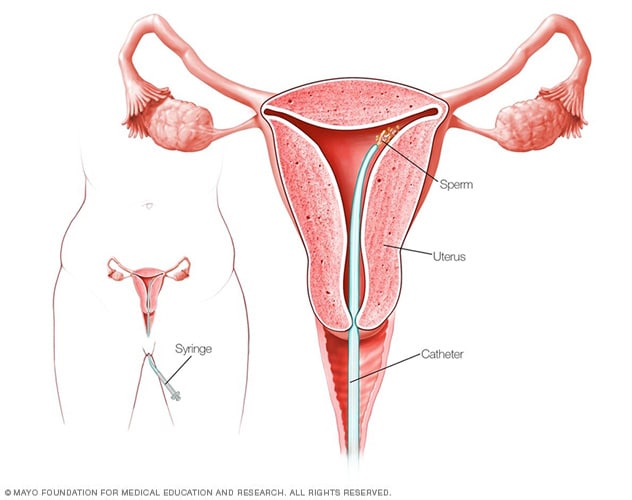 How intrauterine insemination is done