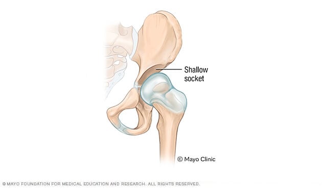 Ilustración de una articulación de la cadera con acetábulo poco profundo.